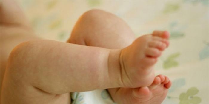 Опрелости у новорожденных, причины, лечение и профилактика